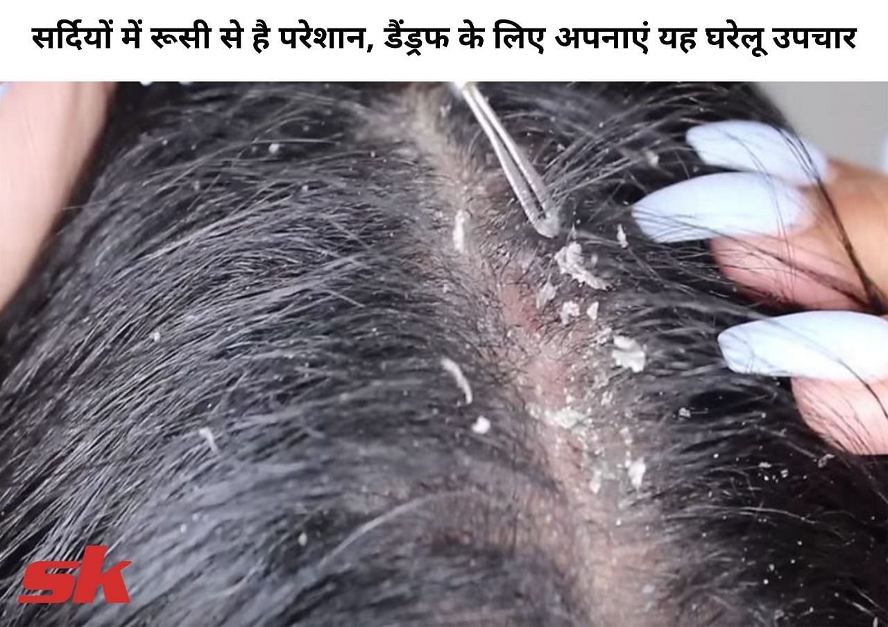 डैंड्रफ के घरेलु उपचार (फोटो - sportskeedaहिन्दी)