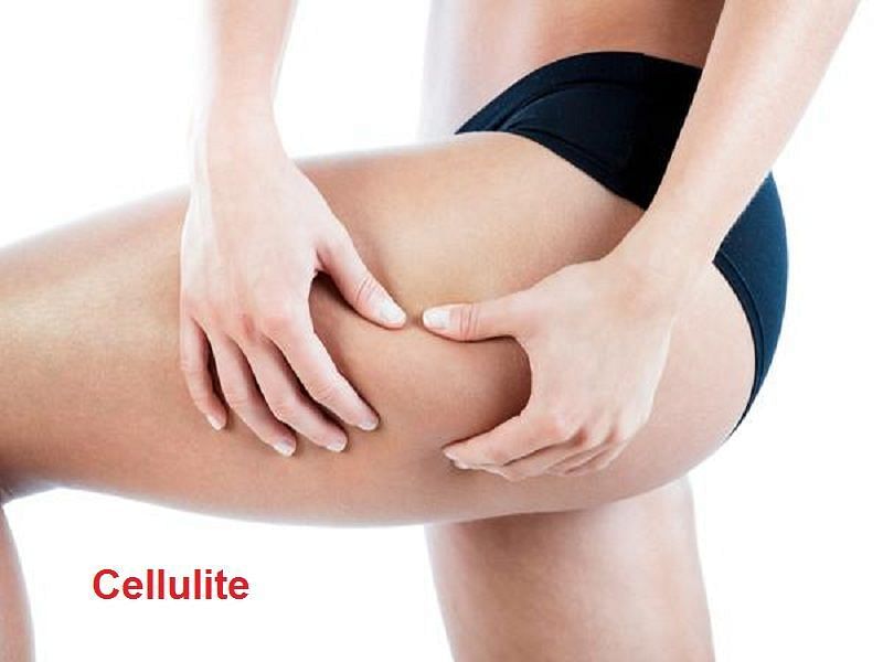 how to help reduce the appearance of cellulite