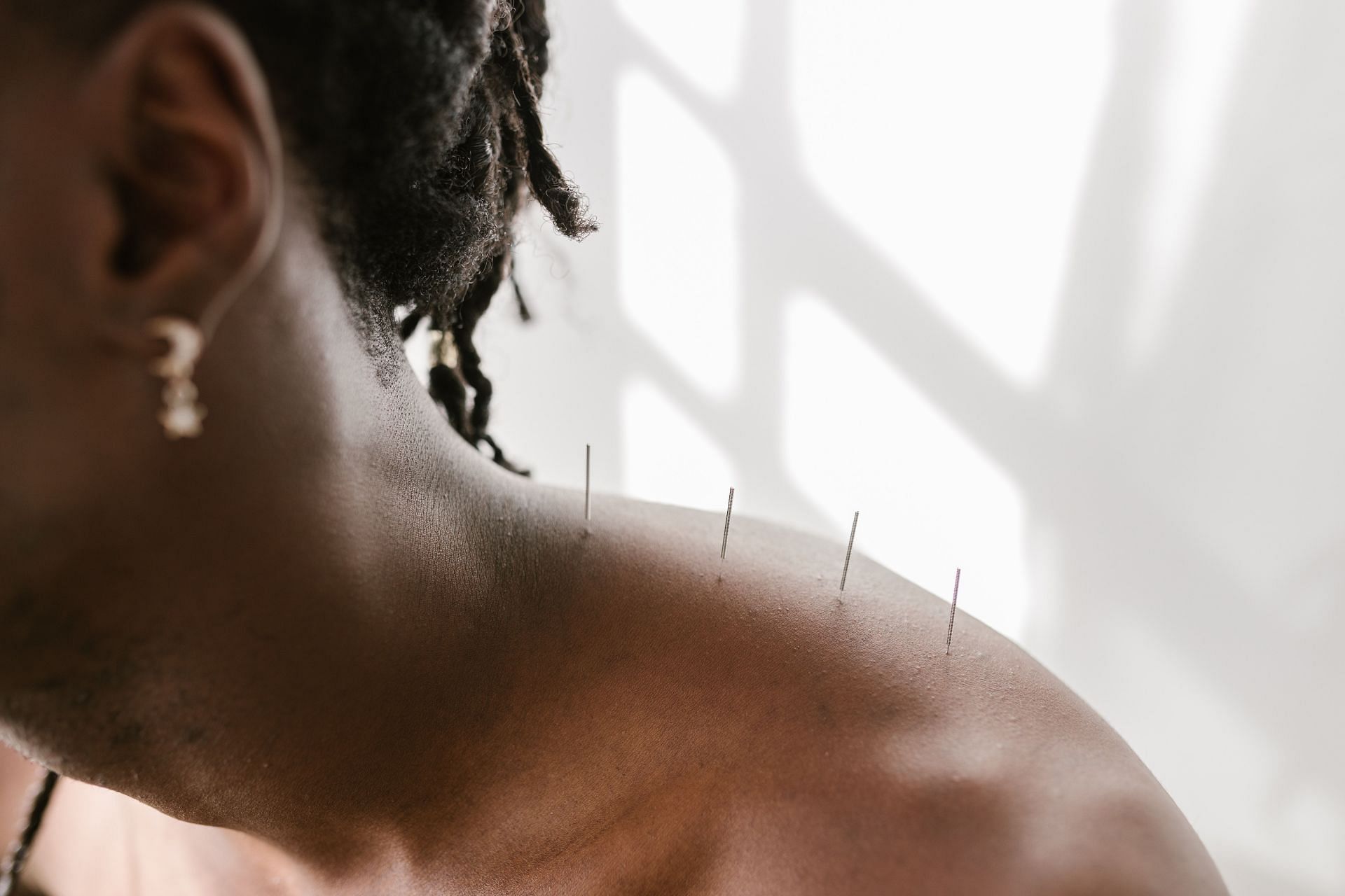Acupuncture can help improve sleep, reducing the risk of weight gain. (Photo via Pexels/RODNAE Productions)