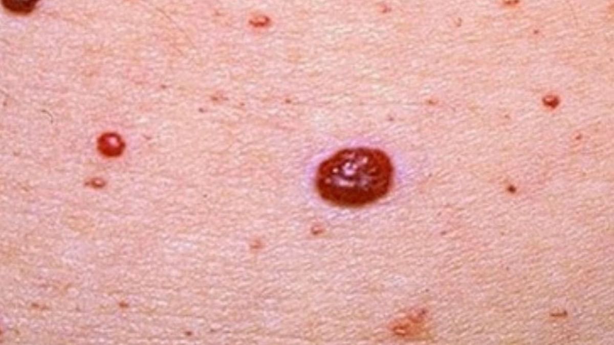 red-moles-on-skin-causes-and-treatment-options