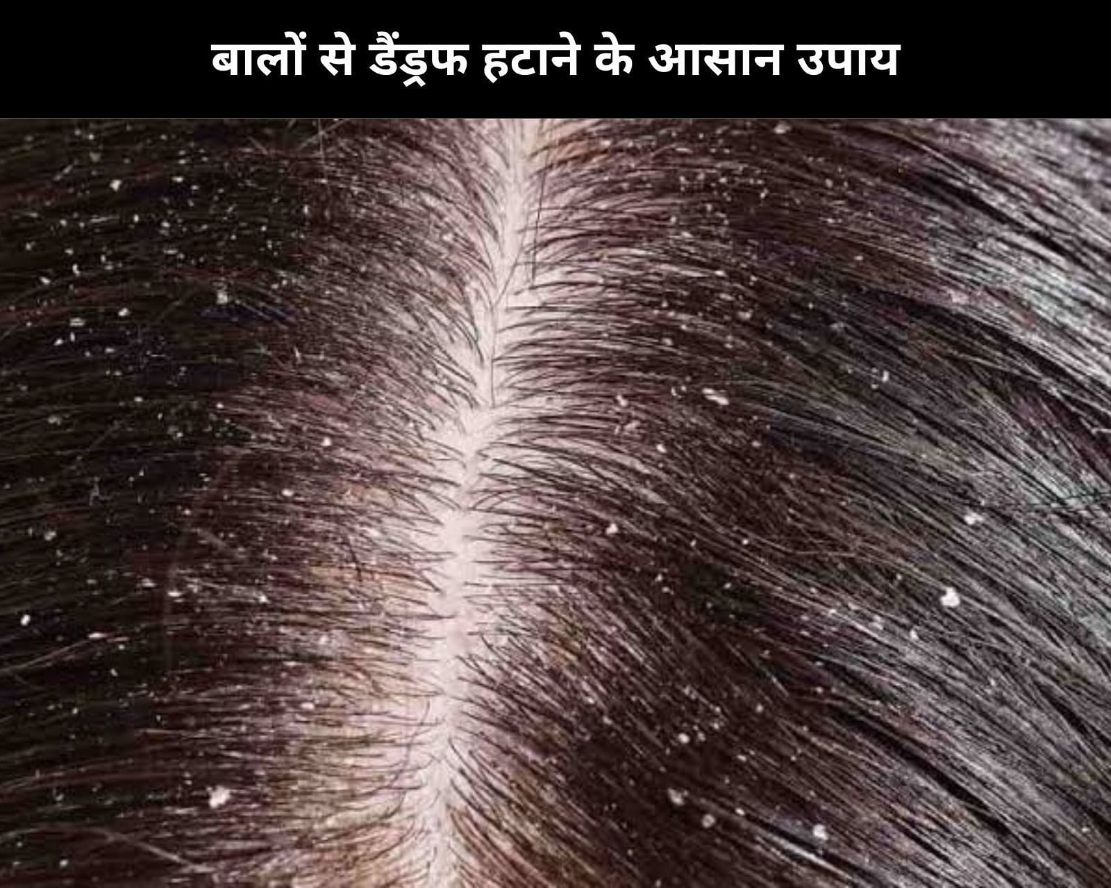 How to get rid of dandruff  Get Healthy Scalp and Hair Growth