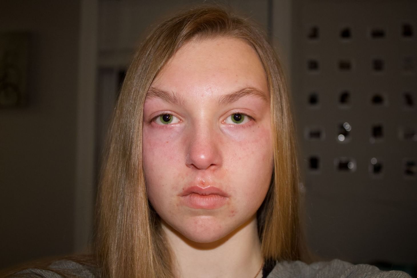 An overview of different types of eczema Signs and treatment