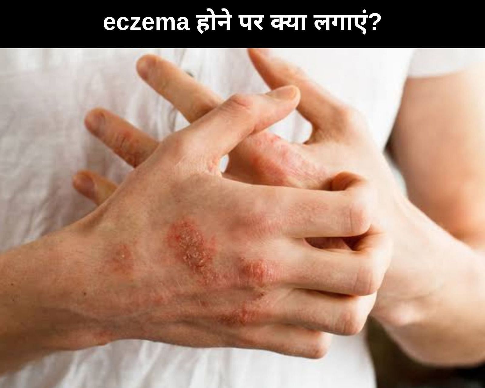 eczema होने पर क्या लगाएं? (फोटो - sportskeedaहिन्दी)