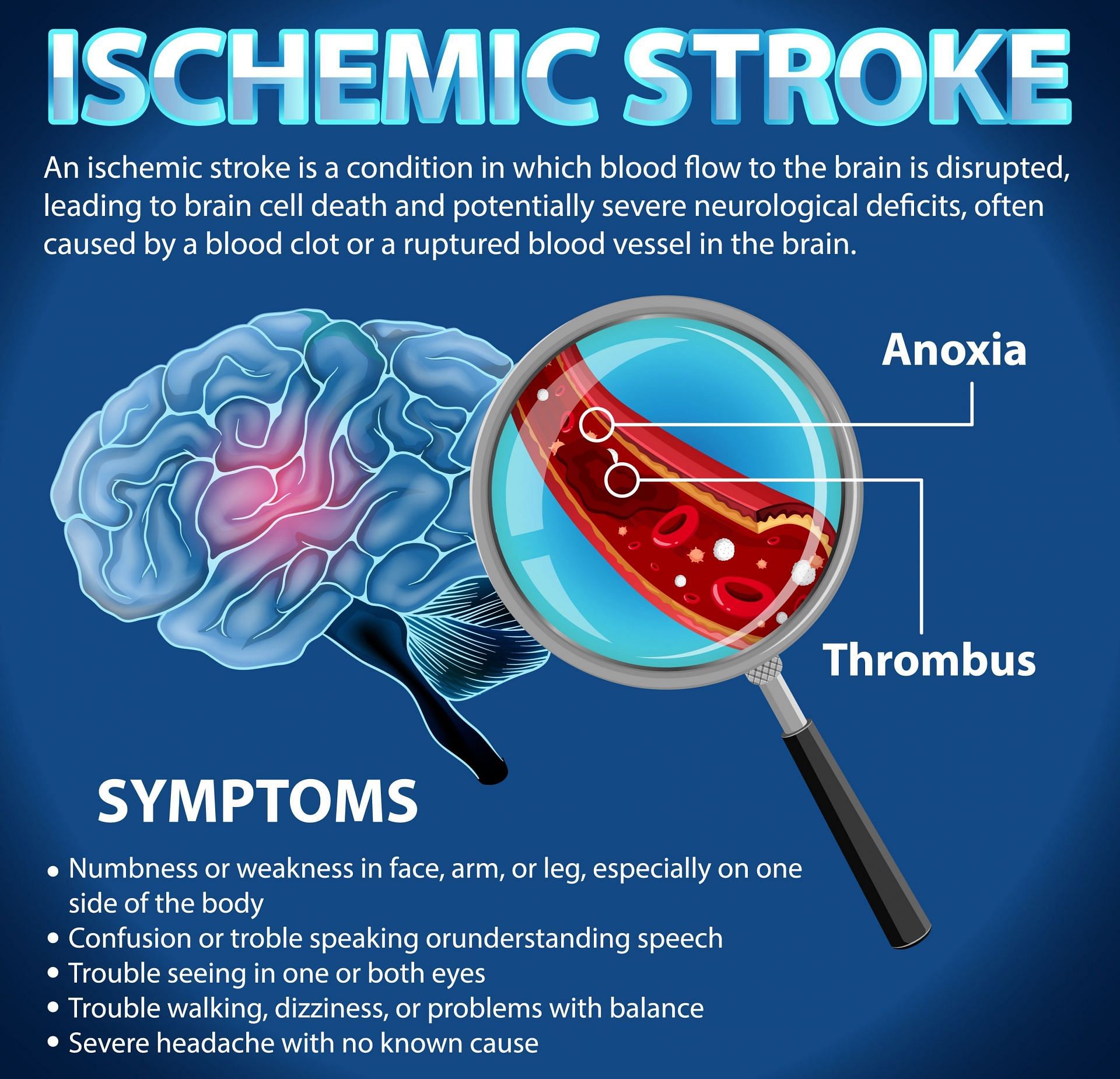 4 main types of dementia: Can stroke cause dementia - Exploring the link