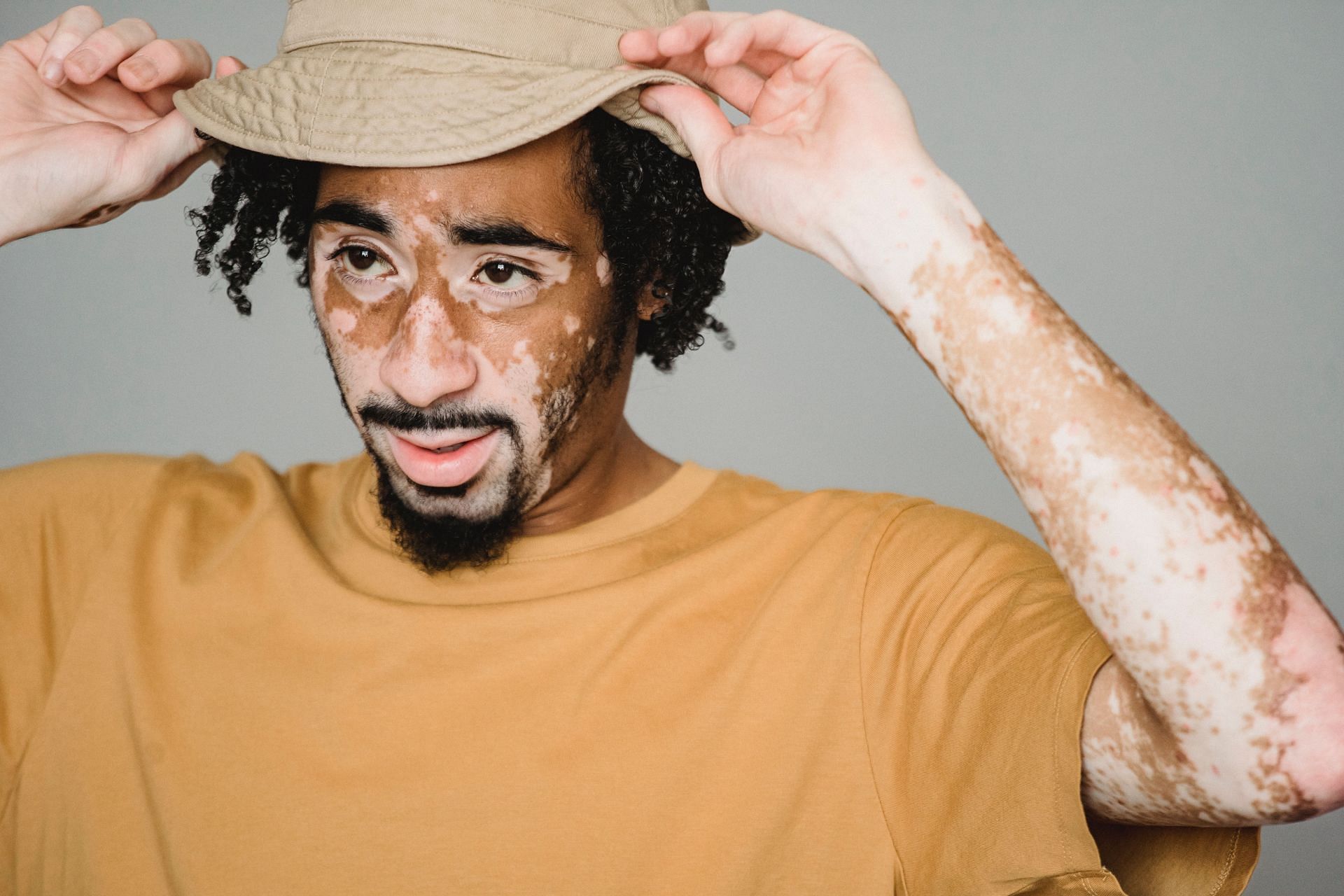 Understanding Vitiligo Causes Symptoms And Treatments 7072