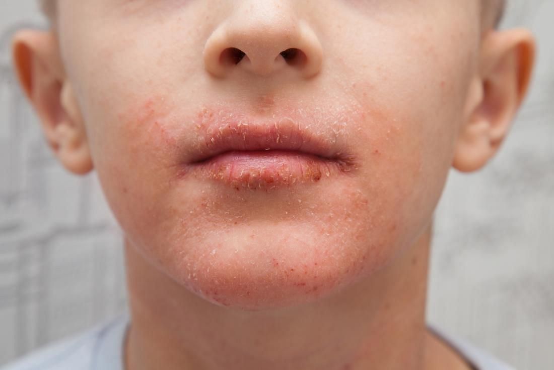 Chemikalien, die in Hautpflegeprodukten verwendet werden, können Reizungen, Trockenheit und allergische Reaktionen hervorrufen.  (Bildnachweis/ Medical News Today)