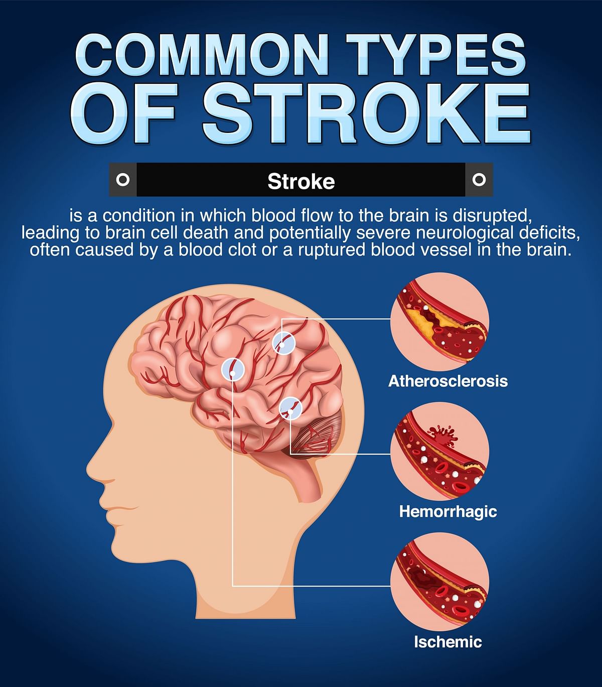 4 main types of dementia: Can stroke cause dementia - Exploring the link