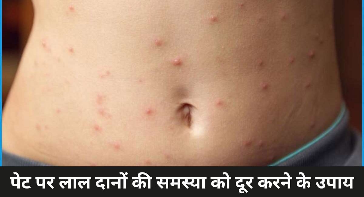 पेट पर लाल दानों की समस्या को दूर करने के उपाय 