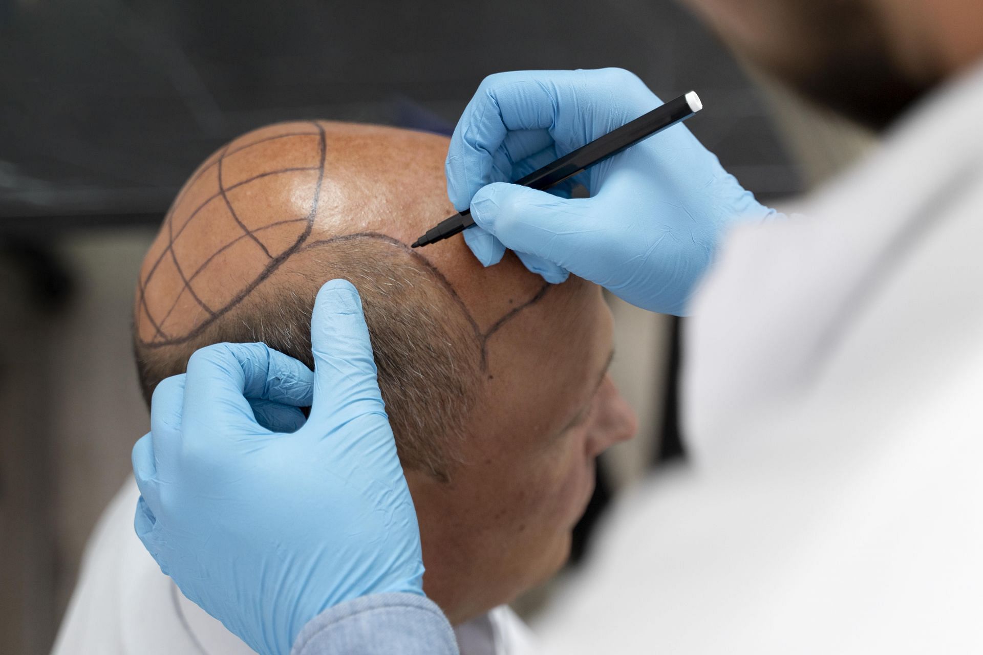 Методы пересадки волос. Повышение квалификации трансплантация волос. Пересадка волос процесс. Пересадка волос реклама.