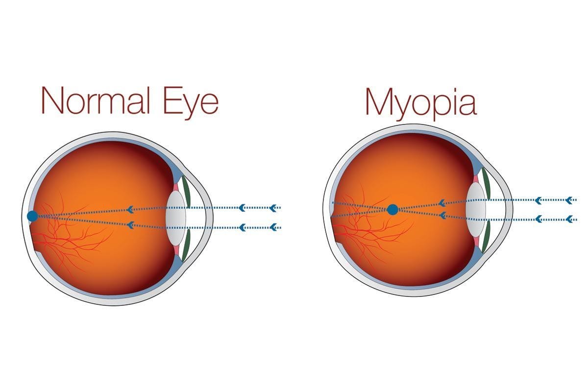 Myopia Control Managing Nearsightedness for Healthy Vision