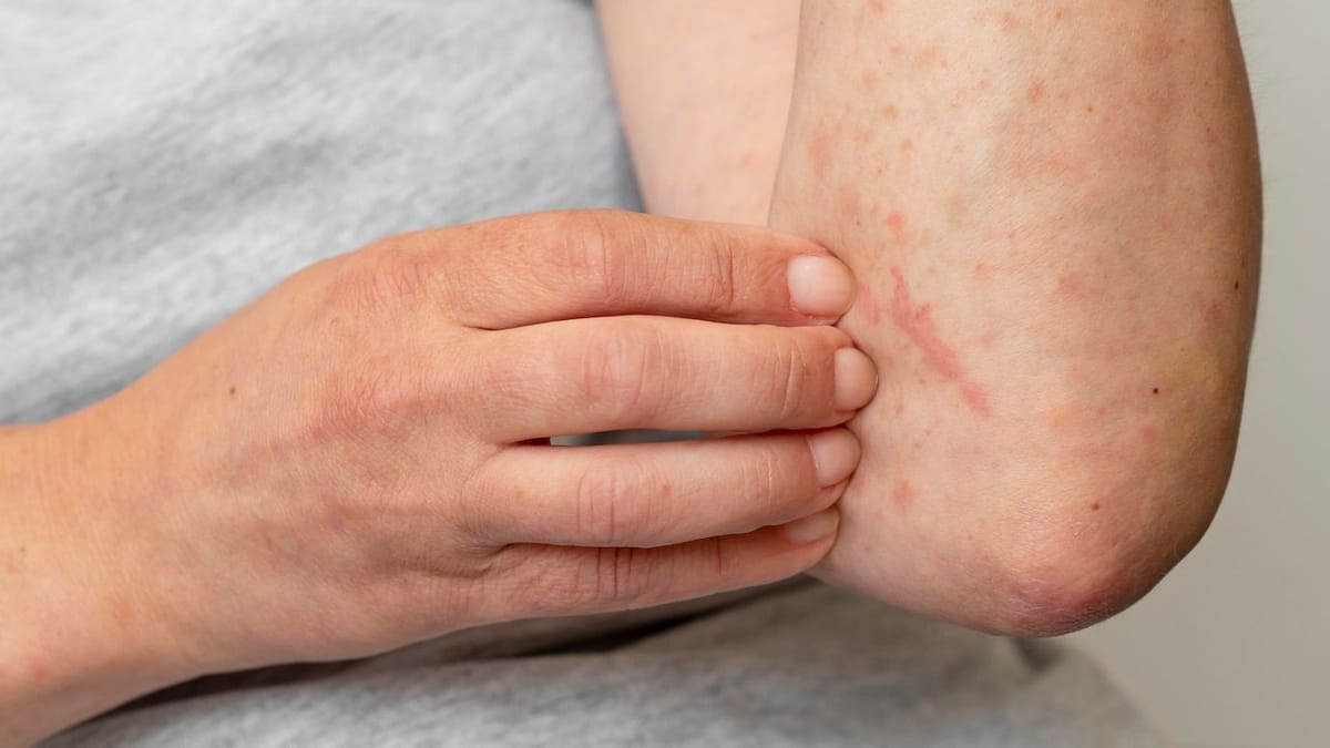 Carbuncles What You Need to Know About These Painful Skin Infections