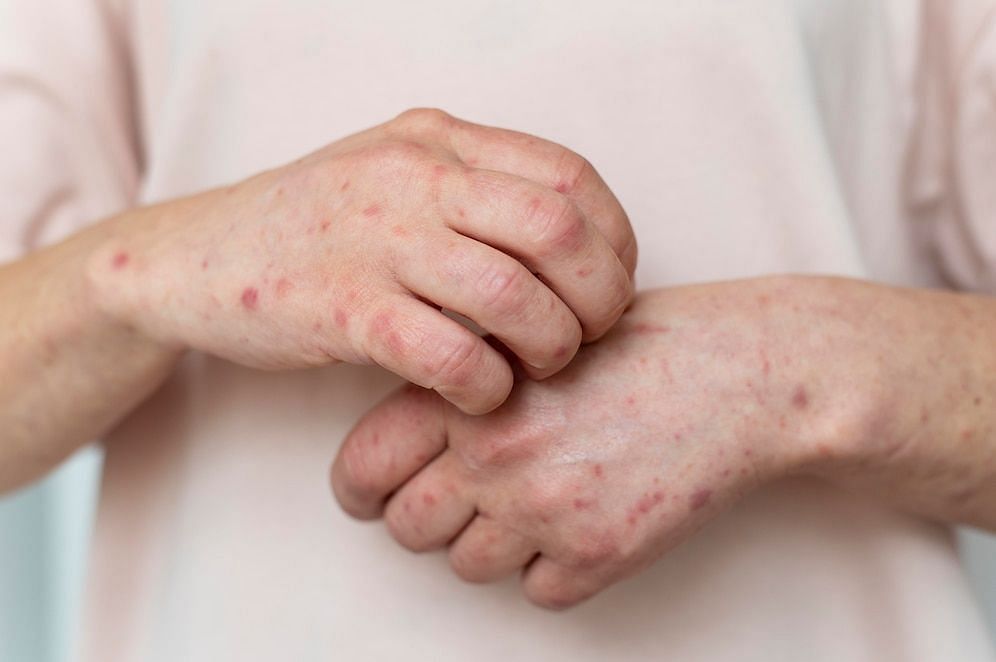 How does the rash occur?  (Image via Freepik)