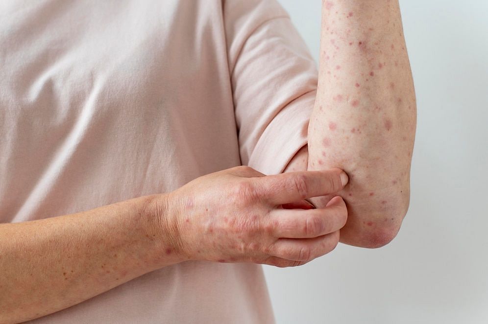 Can this rash spread?  (Image via Freepik)